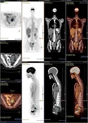 Antiangiogenic Therapy as a New Strategy in the Treatment of Endometriosis? The First Case Report